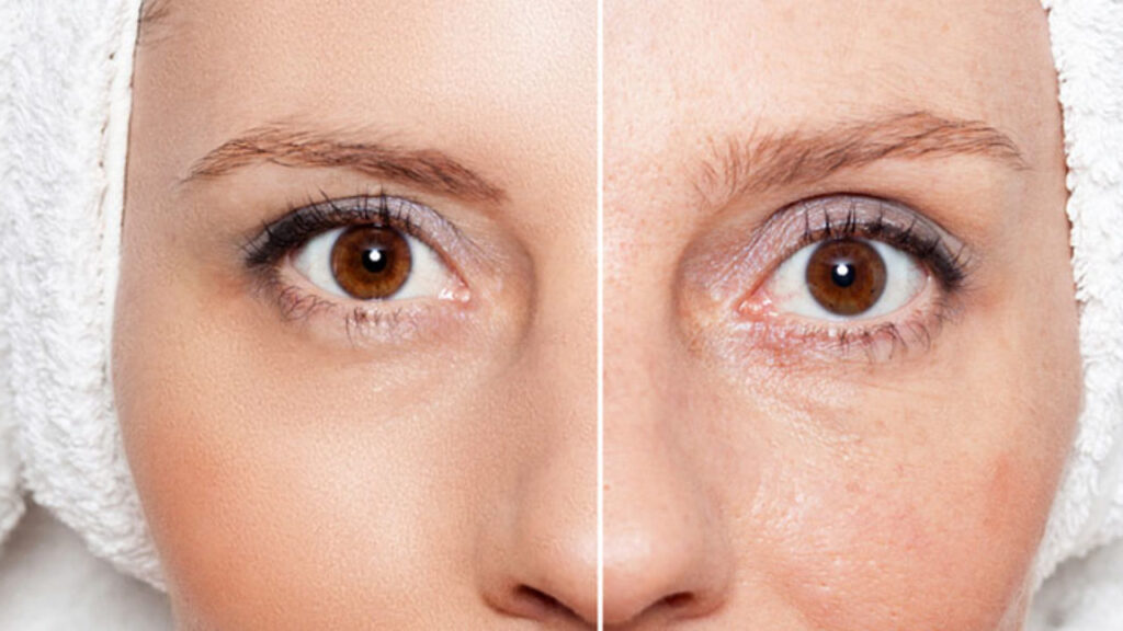 Skin After Microneedling